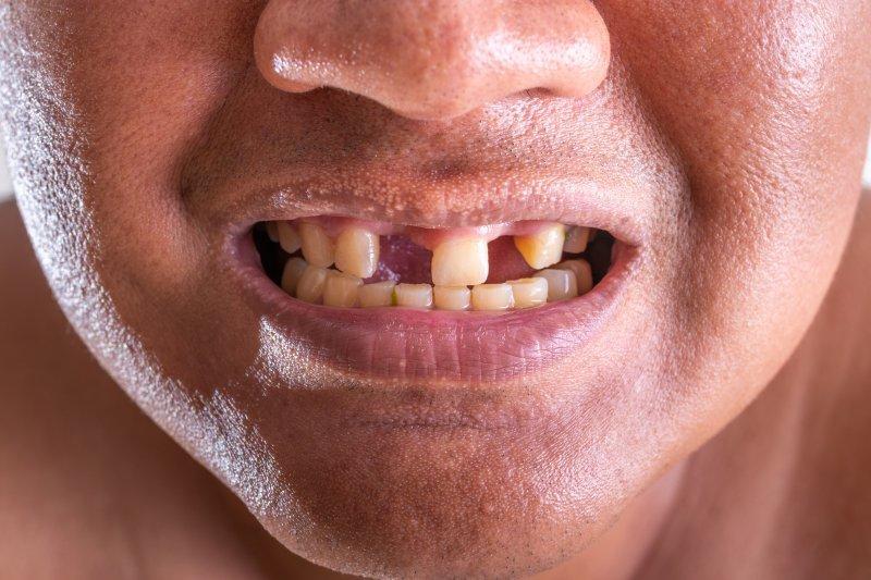 Mơ thấy rụng răng đánh con gì để gặp may?